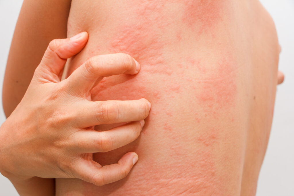 Rash eczema itchy dermatology